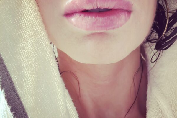 Filler E Medicina Estetica