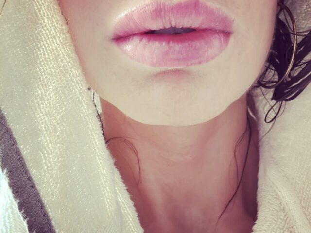 Filler E Medicina Estetica