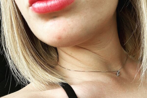 Filler E Medicina Estetica