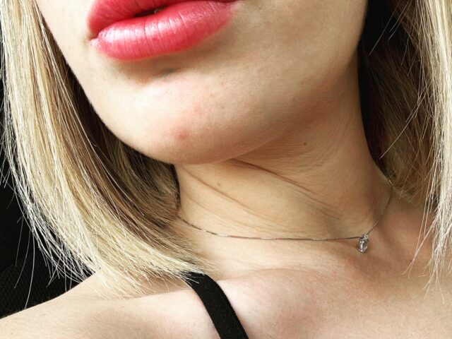 Filler E Medicina Estetica