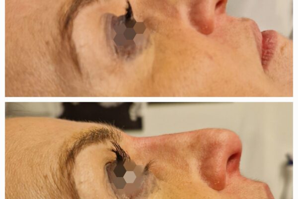Filler E Medicina Estetica