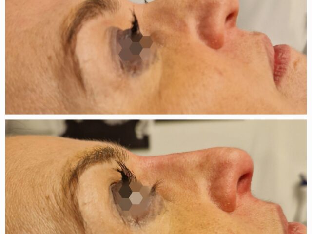 Filler E Medicina Estetica